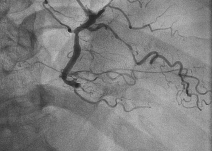 Coronary,Angiogram,(cag),Was,Performed,Chronic,Total,Occlusion,(cto),At